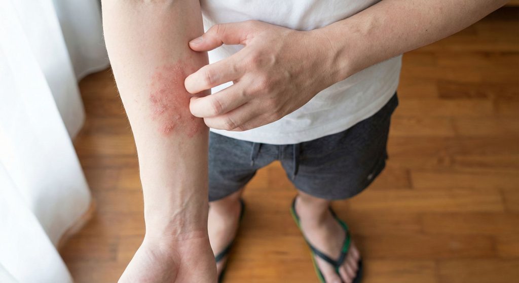Person scratching a red, flaky skin rash on their inner forearm.