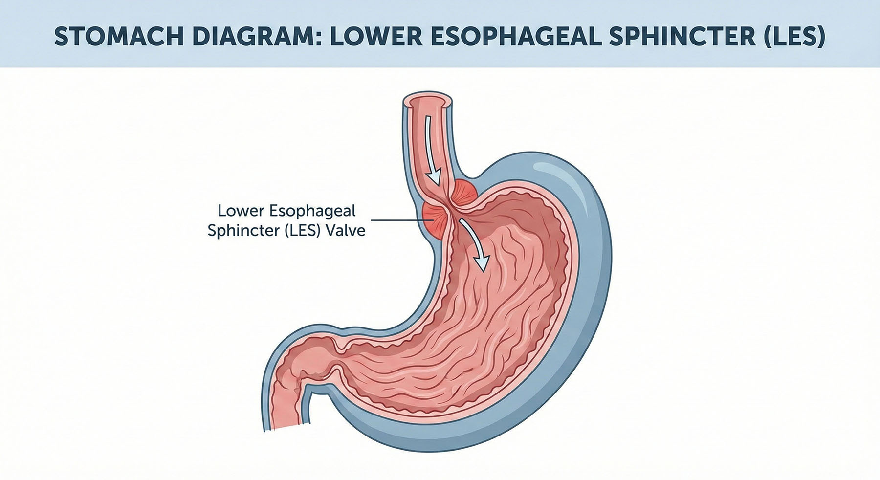 Medical diagram showing a cross-section of the stomach and esophagus, highlighting the location of the Lower Esophageal Sphincter (LES) valve.